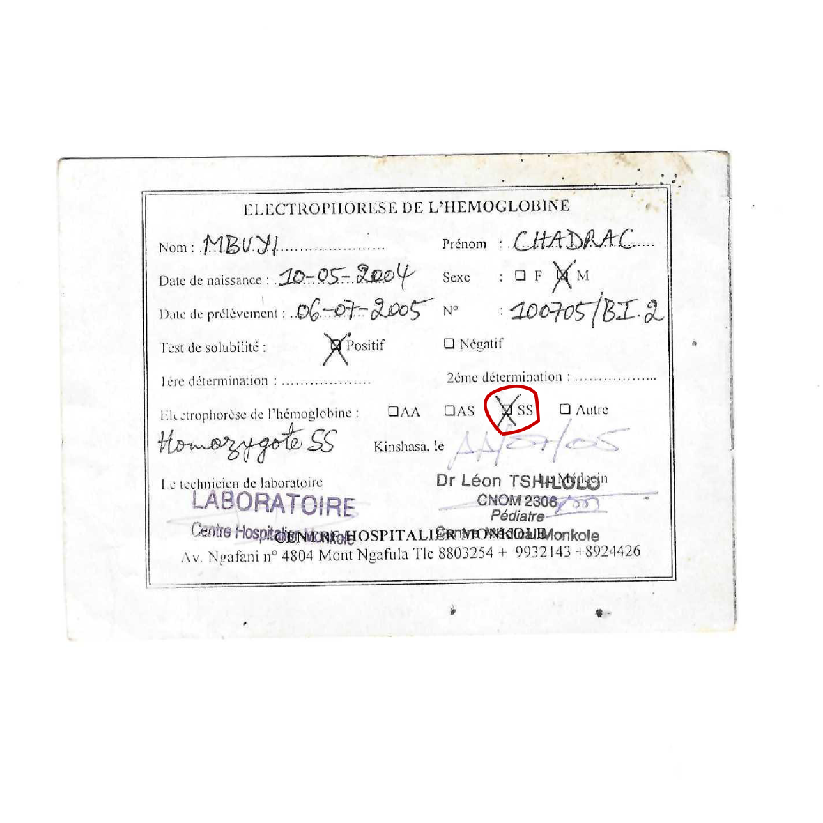 Le Jumeau – diagnostiqué pour la toute première fois comme Homozygote SS (drépanocytose majeure) au Centre Hospitalier Mokole en 2006